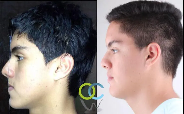 Antes y después: Caso 4: el perfil. El perfil del paciente antes y después de tratar la mordida clase III