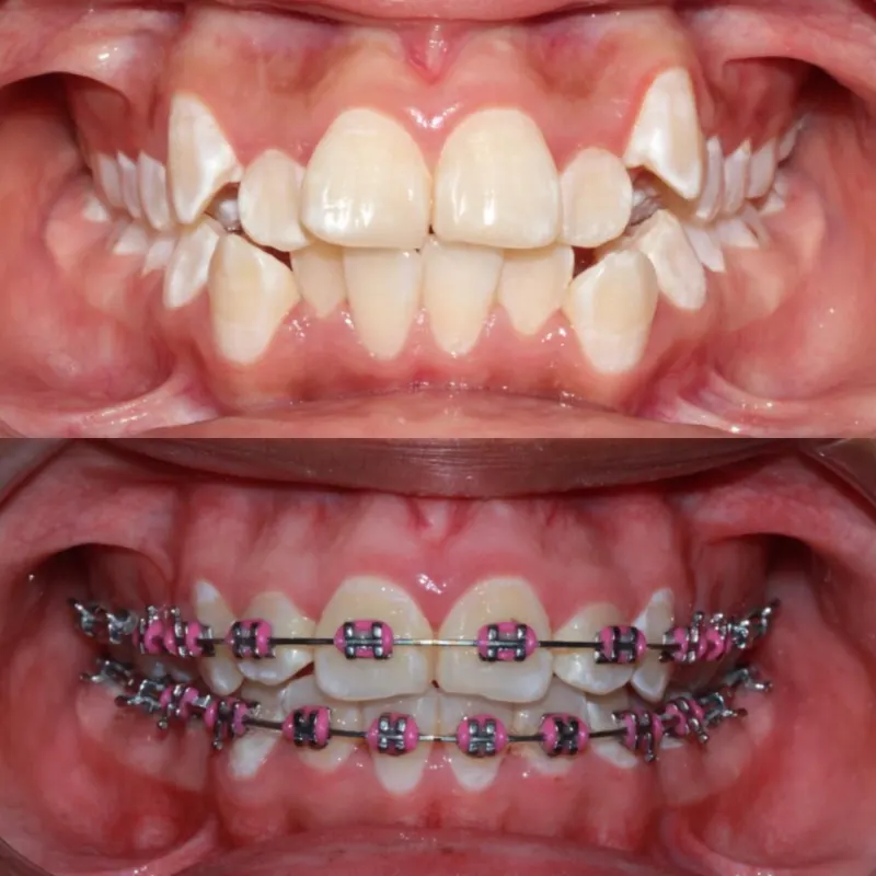 Antes y después: Caso 5: apiñamiento con brackets convencionales. Dientes apiñados corregidos con brackets convencionales