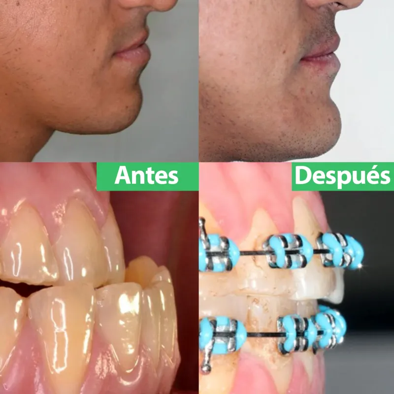 Antes y después: Caso 8: clase III esquelética. Ortodoncia prequirúrgica para alinear los dientes, cirugía ortognática para corregir la mordida y ortodoncia final para los detalles