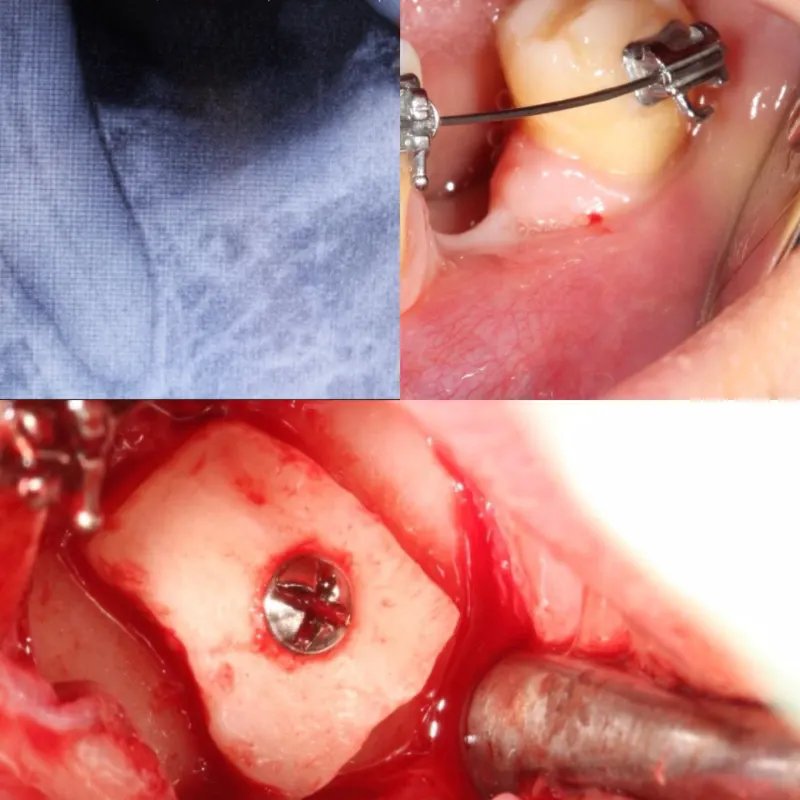 Antes y después: Caso 10: injerto de hueso. Colocación de injerto de hueso autólogo (del propio paciente) como primera fase, para después colocar el implante dental