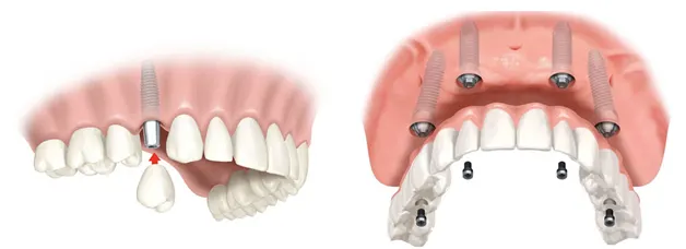 Ilustración de una prótesis fija sostenida por varios implantes