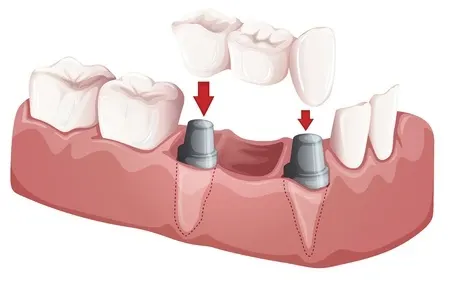 Ilustración de un puente fijo apoyado sobre dos dientes tallados