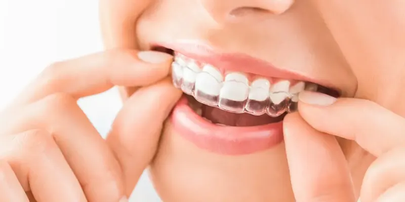 Alineador transparente de ortodoncia invisible sobre los dientes