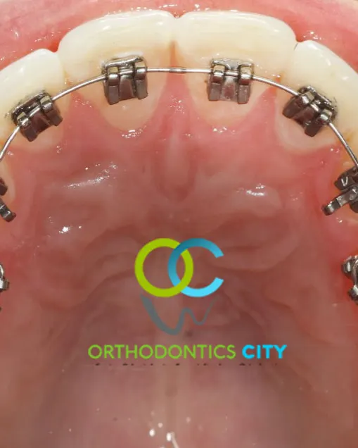 Brackets linguales colocados por dentro de los dientes superiores de un paciente
