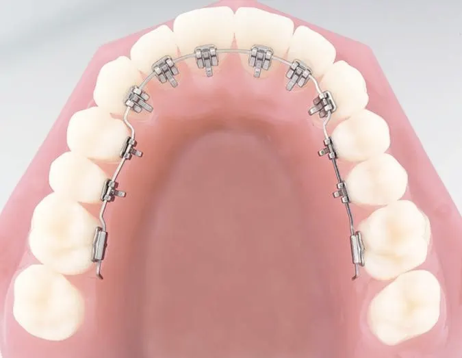 Modelo de arcada dental con brackets linguales en la cara interna