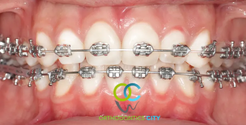 Brackets convencionales metálicos en un paciente de Orthodontics City