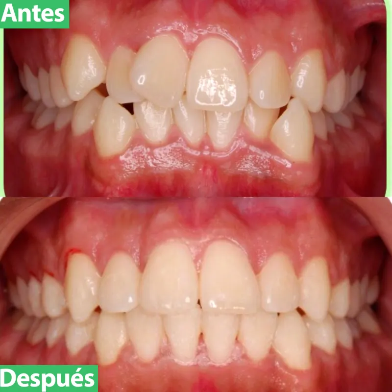 Apiñamiento dental antes y después de la ortodoncia en Orthodontics City