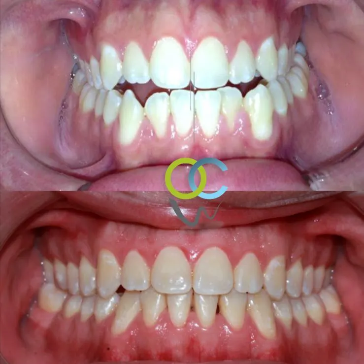 Antes y después: Mordida abierta. Los dientes de adelante vuelven a cerrar