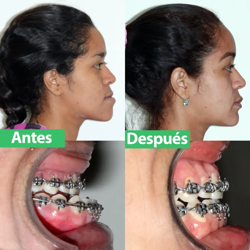 Perfil y mordida de una paciente antes y después de la ortodoncia con brackets en Orthodontics City