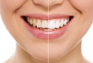 Blanqueamiento Dental en Guayaquil