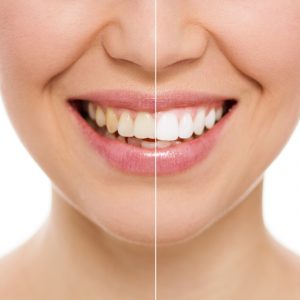 Blanqueamiento Dental en Guayaquil