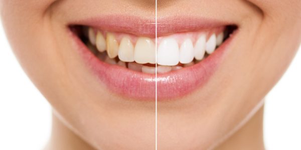 Blanqueamiento Dental en Guayaquil