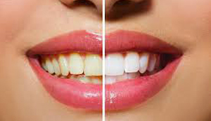 Blanqueamiento Dental en Guayaquil