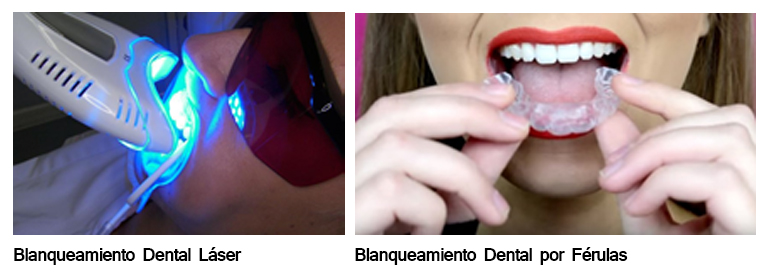 Blanqueamiento Dental en Guayaquil