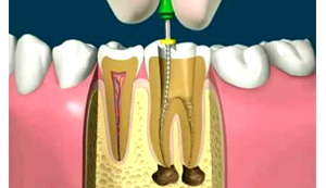 Endodoncia en Guayaquil - Tratamiento de Conducto