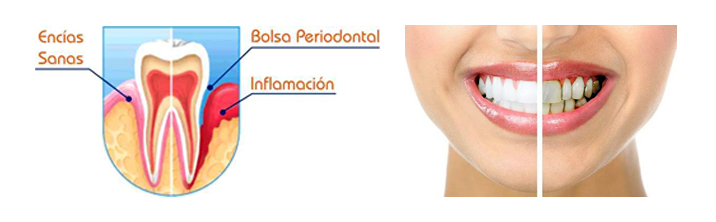 Periodoncia en Guayaquil