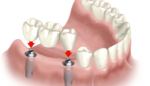 Rehabilitacion Oral Guayaquil