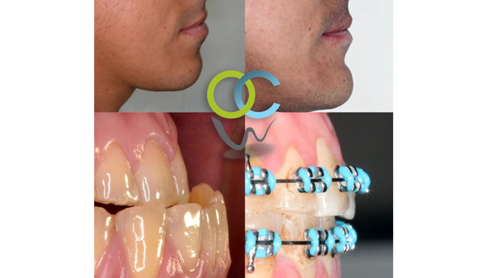 Paciente Ortoquirurgico, presenta asimetría facial con laterognacia hacia la izquierda y mordida cruzada anterior se procedió a colocar los brackets para alinear y nivelar sus dientes, después realizamos la cirugía que consistió en corregir la posición de sus maxilares y luego el paciente continua con la Ortodoncia Post quirúrgica para los detalles finales de su tratamiento. El paciente muestra gran satisfacción por los resultados obtenidos.