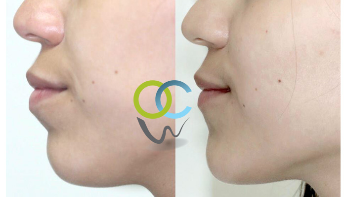 Cambios en el perfil facial, logrados con movimientos de ortodoncia controlados. 